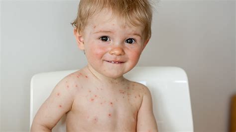 cum se vindecă varicele la bărbați